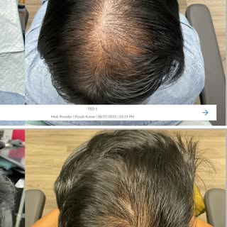 Multi-step treatment, real results. ✨ Bringing back density and confidence. #HairGrowth Journey

#gr