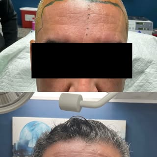 ✨ Restoring the hairline with FUE hair transplant — confidence restored. Happy client, even better r