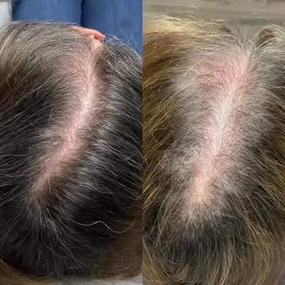 Ready to take the next step toward fuller, healthier looking hair? 

We’re offering FREE hair regrow