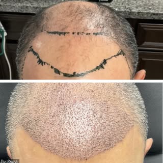 Real results start with the right hair restoration plan ✨

This client is already showing early hair