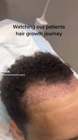 Hairline restored! 💪🏾 This patient underwent an #FUE procedure. It’s a one day procedure that is a