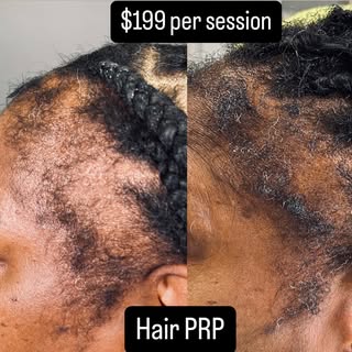 Don’t wait til it’s too late! #hairprp will help strengthen and regrow your hair! Just $199

☎️Inves