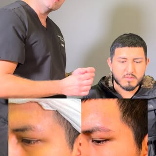 Beard and Eyebrow Transplant! Permanent solution x awake procedure #regainyourconfidence

Schedule a