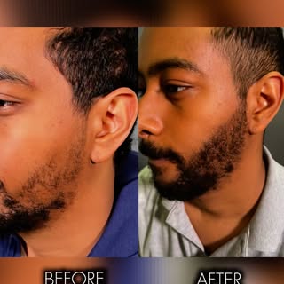 Where the beard meets perfection 😎#beardtransplant 

Schedule a free consultation today! 📲703-220-