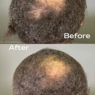If you’ve been noticing hair loss — this is your sign to start.

PRP can bring your hair back — natu