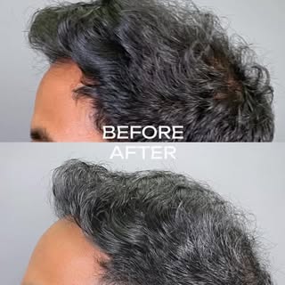 Just a real result 🤩

To book your appointment or consultation call us via 
703-220-1836 📞

#hairp