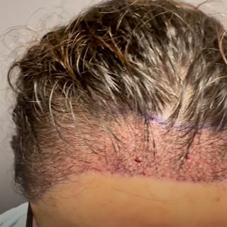 Here’s a look inside our hair transplant process — precise, safe, and fully customized to your hairl