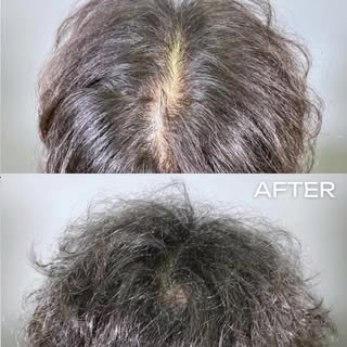 Your hair is thinning? Here’s how PRP actually brings it back 👇✨

PRP = Platelet-Rich Plasma — your
