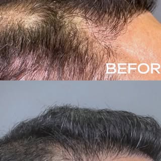 A natural boost your skin or hair has been waiting for ✨
PRP uses your own growth factors to restore