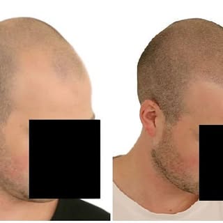 My work#
microhairpigmentation#
scalppigmentation#
hairtattoo#allmyworkat
@prohairclinic.com