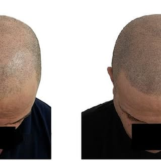 SMP#before and after 3 sessions#new hairline#new hairstyle#hairlinedesign#
hairsimulation#no differe