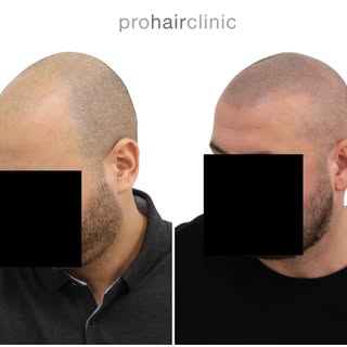 My art of scalppigmentation.
Result after 3 sessions.
No more baldness😊

Hairtattoo#pigmentation#
s