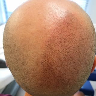 Work in progress # first session# a thousend dots#
scalppigmentation#
hairpigmentation#hairtattoo#
n