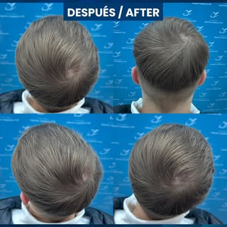 📸 Antes/ Después / Injerto Capilar
Técnica FUE 2230 Folículos (5748 cabellos) realizado
por el Dr. 