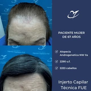 📸 Antes/ Después / Injerto Capilar
Técnica FUE 2290 Folículos (5333 cabellos) realizado
por el Dr. 