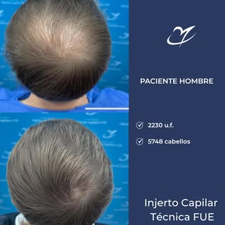 📸 Antes/ Después / Injerto Capilar
Técnica FUE 2230 Folículos (5748 cabellos) realizado
por el Dr. 