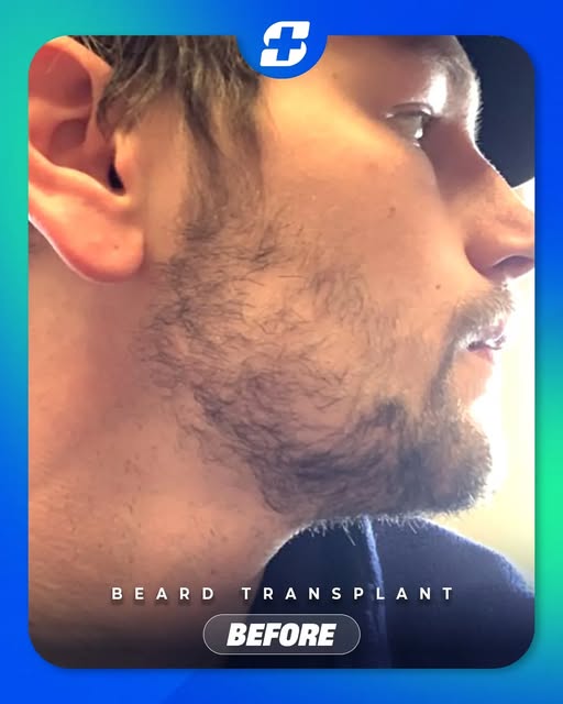 A fuller beard starts with a well-planned approach. ⭐

Swipe to see the result.

📩 Thinking about a