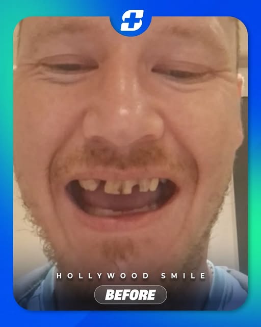 A refined smile, created with zirconium crowns. 🦷💖

This before & after shows how carefully design
