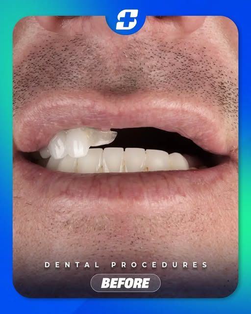 🌺 A closer look at the details that make a smile feel complete. 

Swipe through to see the dental t