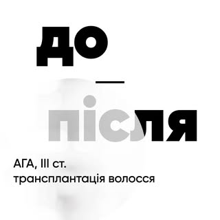 ТРАНСПЛАНТАЦІЯ ВОЛОССЯ FUE У ЧОЛОВІКА. ПРОМІЖНИЙ РЕЗУЛЬТАТ

Пацієнт звернувся до клініки у 38 років 