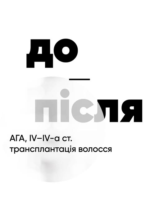 ТРАНСПЛАНТАЦІЯ ВОЛОССЯ FUE У ЧОЛОВІКА. РЕЗУЛЬТАТ ЧЕРЕЗ 10 МІСЯЦІВ

Пацієнт звернувся до клініки у 43
