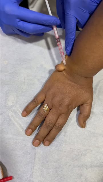Not every skin tag is found where you’d expect! 👀✨
This was an unusually large skin tag on the hand