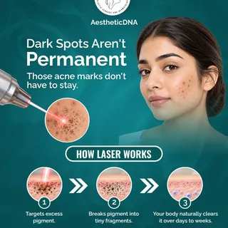 Dark spots and acne marks don’t have to stay forever.
Laser treatment can target excess pigmentation