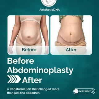 From excess skin and abdominal laxity → to a flatter-looking, more defined abdominal contour. ✨

Abd