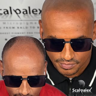 Natural Hairline with SMP✅

visit www.scalpalex.com for more info

2023 MoMs winner
@ghostpigment pr