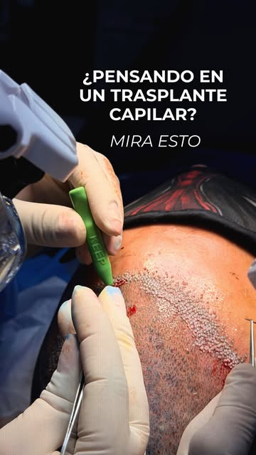 ¿PENSANDO EN UN TRASPLANTE CAPILAR? MIRA ESTO 🚨

Te mostramos el paso a paso de un procedimiento de