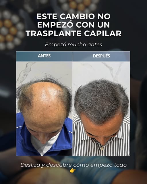 Este cambio no empezó con un trasplante capilar… empezó con una estrategia. ✨

Primero fortalecimos 
