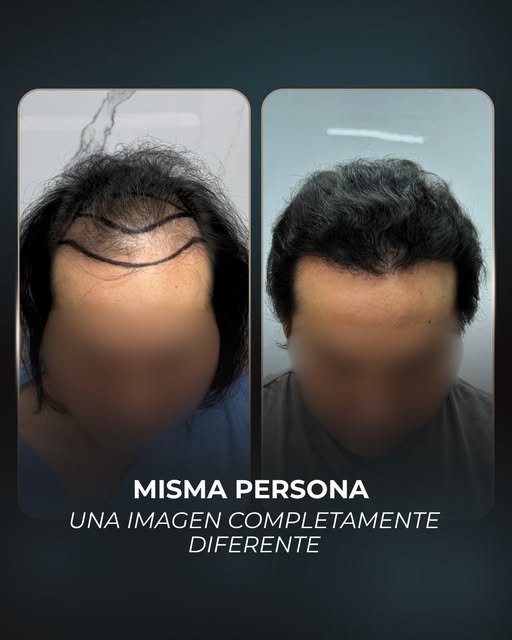 Misma persona. Una imagen completamente diferente. ✨

Donde antes faltaba cabello, hoy hay mayor cob