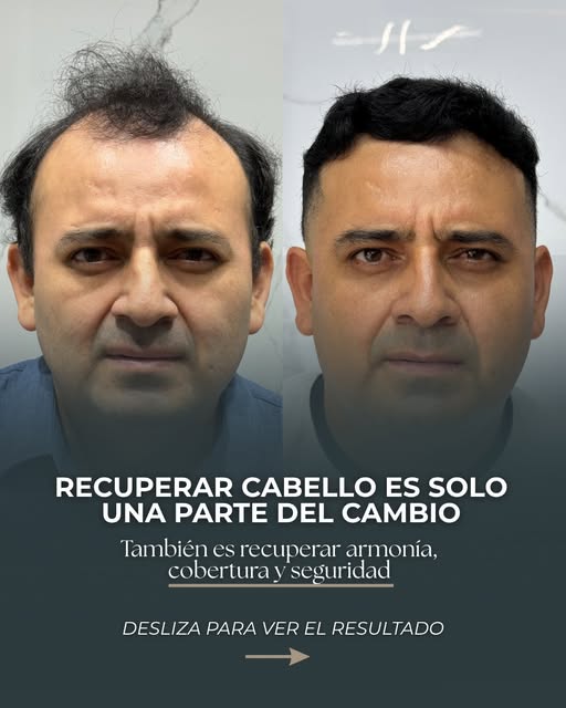 ✨ Un trasplante capilar no se trata solo de recuperar cabello, sino de saber dónde y cómo colocarlo.