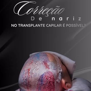 👃🏻 Seu nariz é um pouco torto? O transplante capilar pode ajudar a amenizar visualmente essa assim