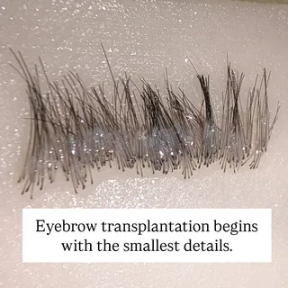 This is where a natural-looking eyebrow transplant begins.

Each follicle is carefully selected and 
