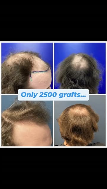 Only 2,500 grafts — by design.

Because this patient is young, our goal was not only to achieve good