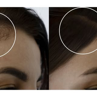 A holistic approach to hair restoration awaits you. Begin your journey towards revitalized hair and 
