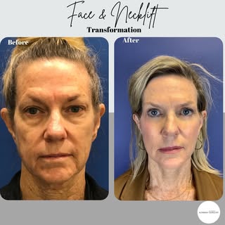 Amazing! This patient desired a more youthful and refreshing look for a very important family event.
