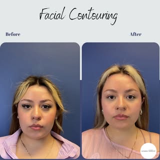 “ I’ve always had a fuller face , even when I lost weight” 
That was this patient’s biggest concern.