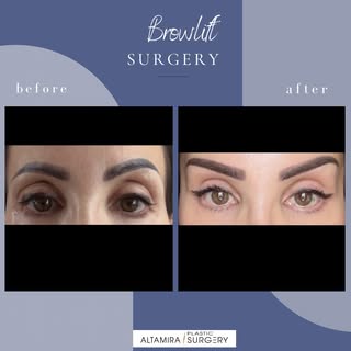 The EYES don’t lie…
A brow lift can make a dramatic difference without looking over done. By lifting