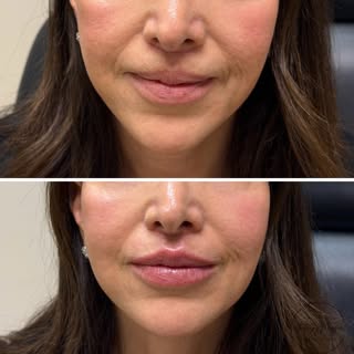 Subtle definition, beautiful results 💋

This client chose 0.5 ml of lip filler to enhance the lip b