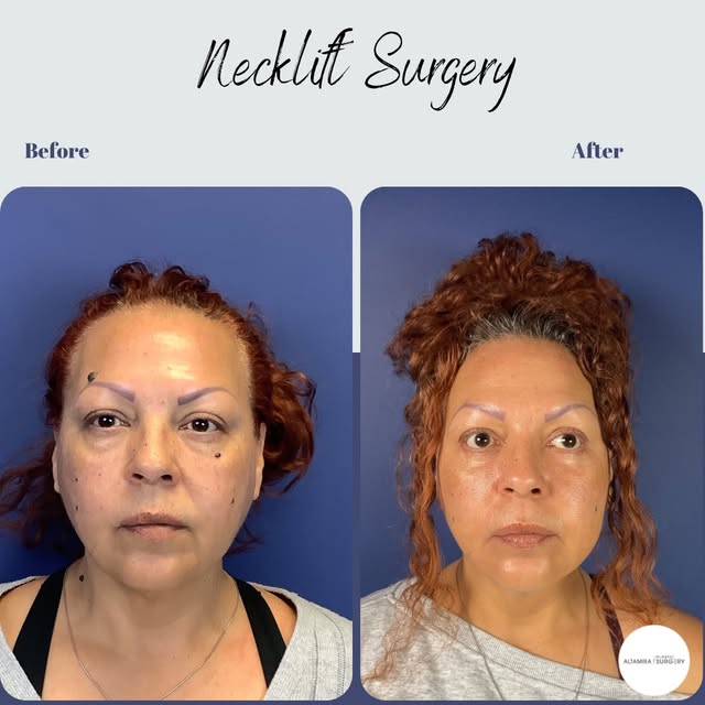 The goal behind this transformation—not to change her features, but to create a more youthful, balan