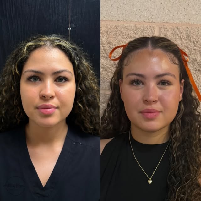 A beautiful example of how masseter neuromodulator can be used for both medical + aesthetic purposes