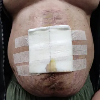 Tinea corporis infection over post operative wound