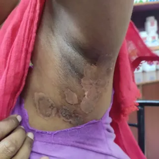 Tinea corporis infection over axilla burned with local application medication -- not recommended