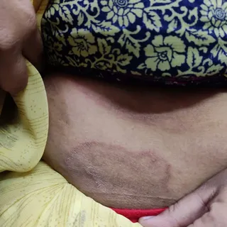 Tinea corporis infection over abdomen of a female patient