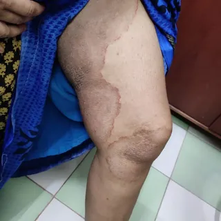 Tinea cruris with tinea corporis over thigh and knee of a female patient