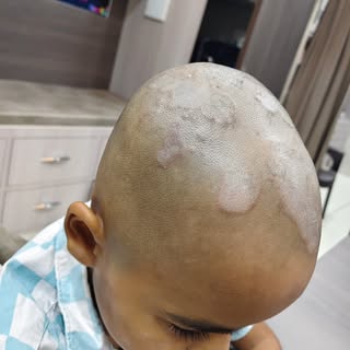 Tinea capititis completely cured with medicines