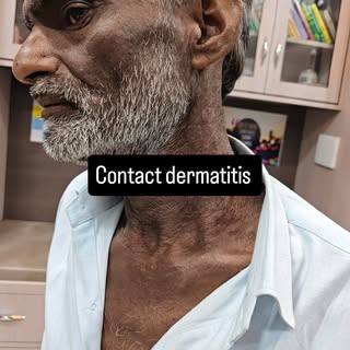Contact dermatitis cured completely with medicines