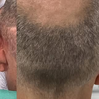 🩺✨ Tricopigmentation après greffe de cheveux FUT ✨🩺

Vous avez subi une greffe capillaire de type 